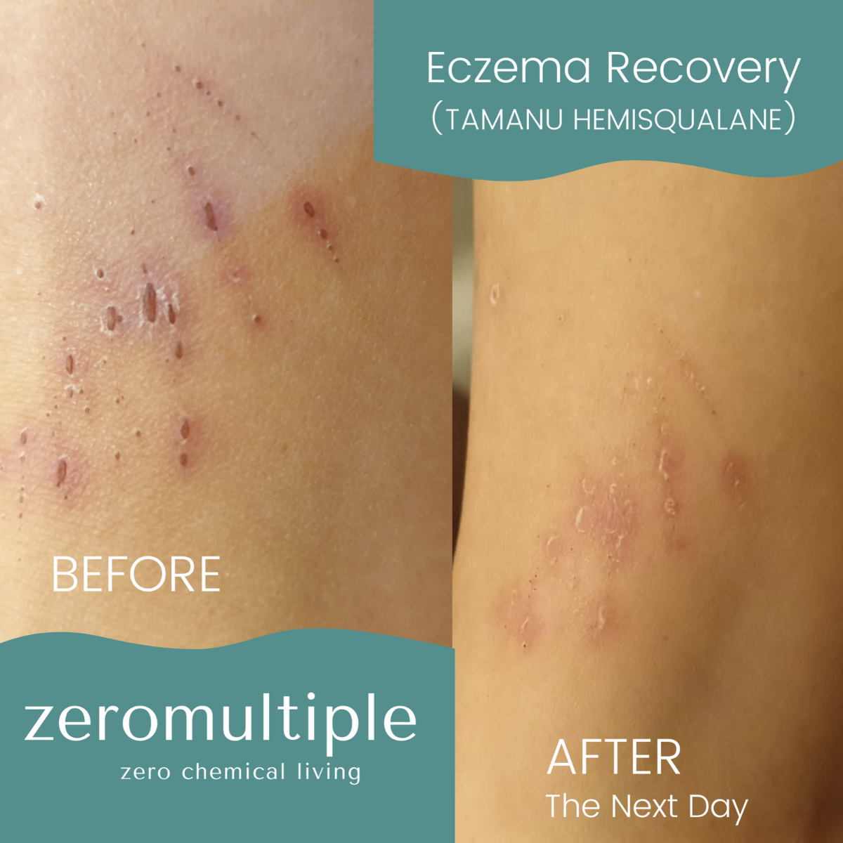 Eczema skincare set