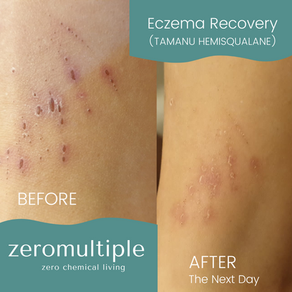 Eczema skincare set