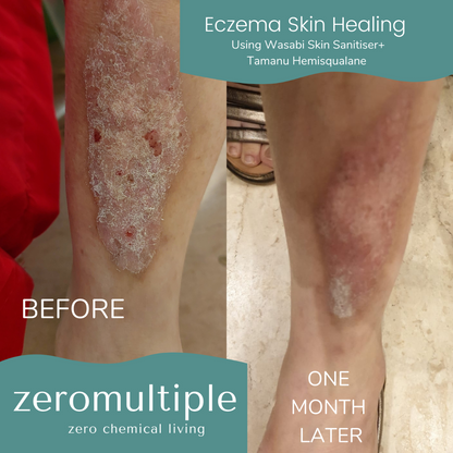 Eczema skincare set