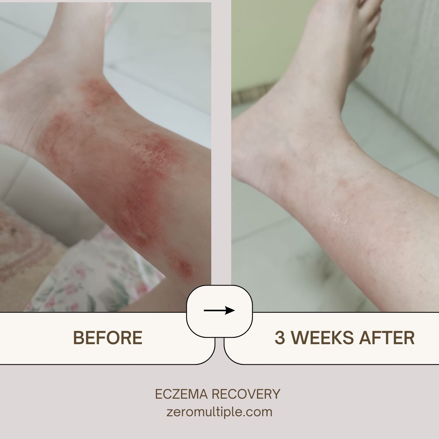 Eczema skincare set