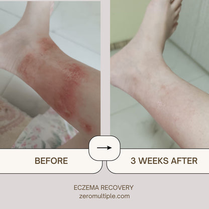 Eczema skincare set