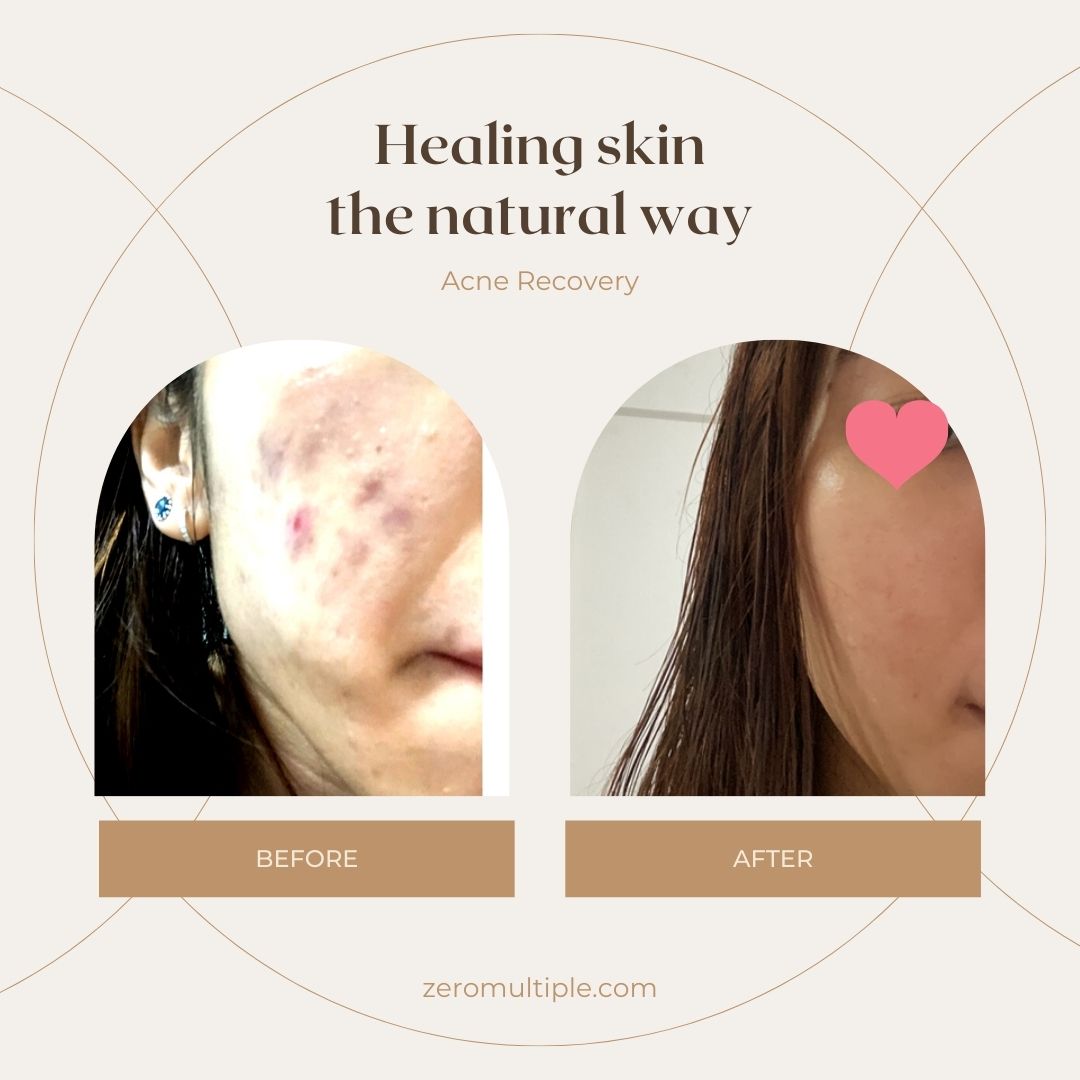 Acne_XJ _Thaanka anti acne